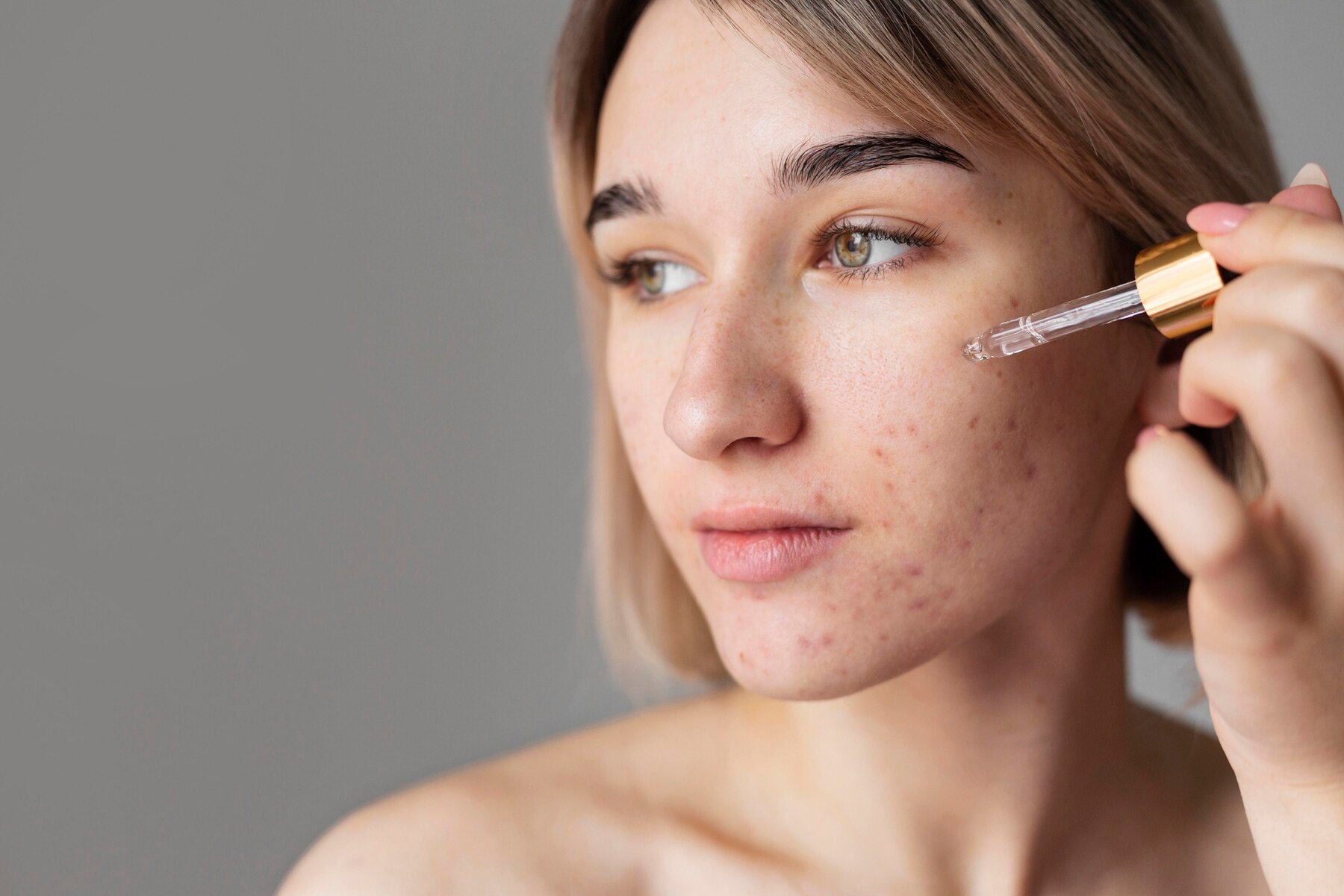The Ultimate Solution for Acne and Blemishes